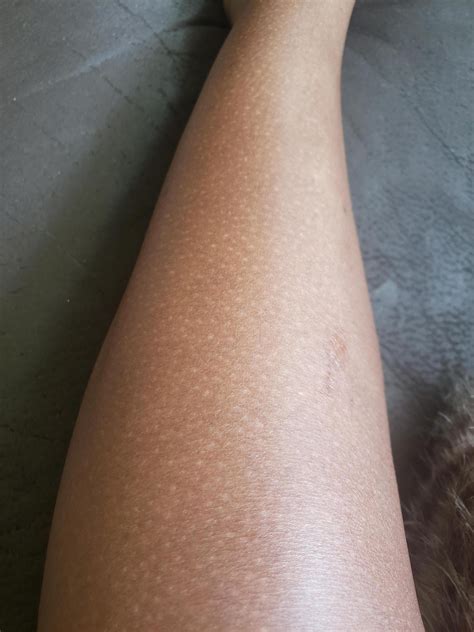 Help Tiny White Spots On Arm And Legs Skin Care Talk Atelier Yuwa