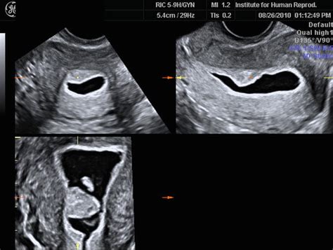 Sonohysterography In Reproductive Medicine Radiology Key