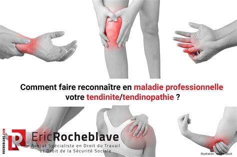 Comment faire reconnaître en maladie professionnelle votre tendinite