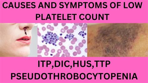 Causes And Symptoms Of Low Platelets Itp Dic Ttp Hus And Thrombocytopenia Work Up In Low