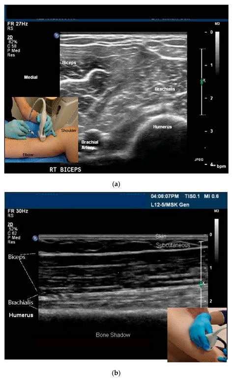 Toxins Free Full Text Ultrasound Guidance For Botulinum Neurotoxin