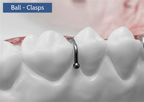 Clasps Universal Orthodontic Lab