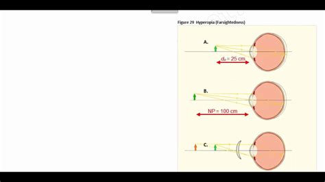 Oat Optics Finding Focal Length And Refractive Power Correcting