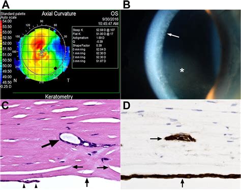 Posterior Polymorphous Corneal Dystrophy Clinical Pathologic