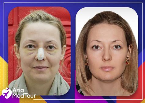 Nose Job Recovery Bruising