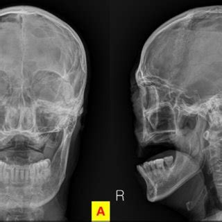 Skull X Ray Anteroposterior Ap And Lateral Views Performed In Erect