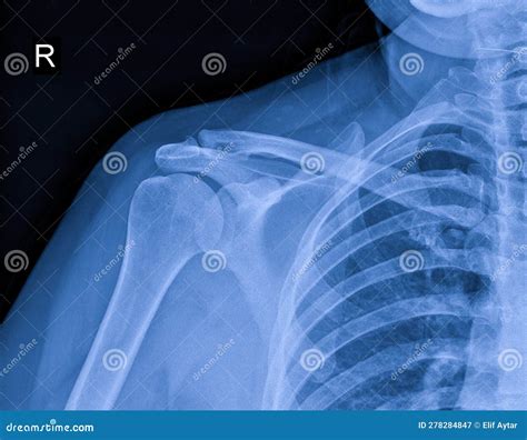 X Ray Image Of Shoulder Pain Shoulder Ligament Tendinitis Shoulder Muscle Strain Stock Image