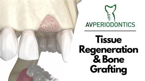 Tissue Regeneration And Bone Grafting Manhattan Ny Dr Alexander