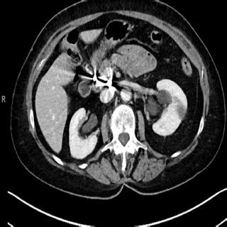 Postprocedural changes of splenic artery aneurysm embolization without ...