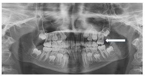 Ectopic Eruption Of The First Permanent Molar In The Maxilla Cephalometric Features Of 13