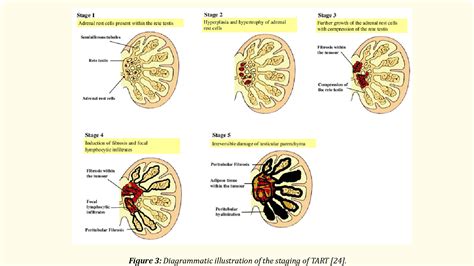 Figure 1 From Imaging Features Of Testicular Adrenal Rest Tumors In