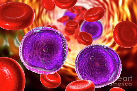 Acute Lymphoblastic Leukaemia Photograph By Kateryna Kon Science Photo