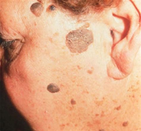 Seborrheic Keratosis Causes Symptoms And Treatment Healthevoke Hot