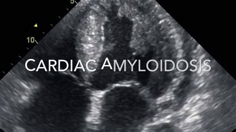 Cardiac Amyloidosis (case No.2) - YouTube