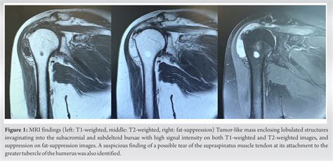 Severe Shoulder Pain Caused By Lipoma Arborescens In The Subdeltoid Bursa A Case Report