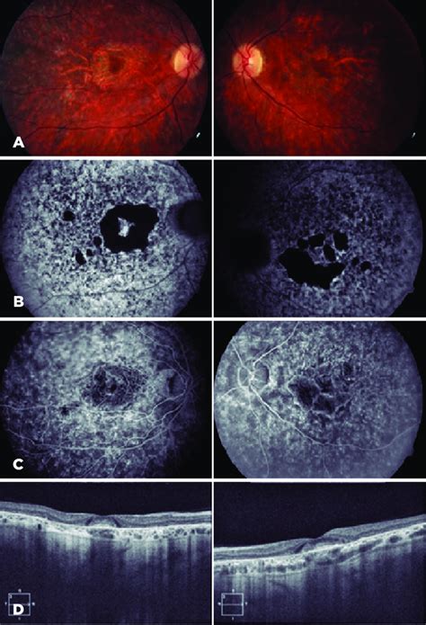 (A) Fundus showing atrophy of the perifoveal RPE and choriocapillary ...