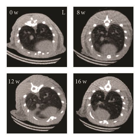 Evaluation Of Radiation Induced Lung Fibrosis A Manifestation Of