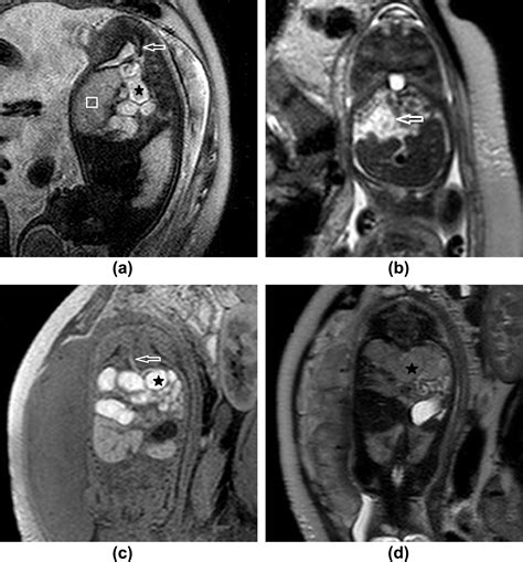 Using Prenatal Mri To Define Features Of Meconium Peritonitis An