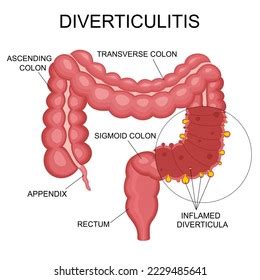 Diverticulitis Diverticulosis Vector Illustration Medical Structure