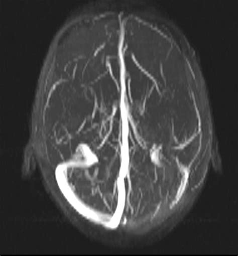 RADIODIAGNOSIS - IMAGE COLLECTION: DURAL SINUS THROMBOSIS IN A PATIENT OF ULCERATIVE COLITIS