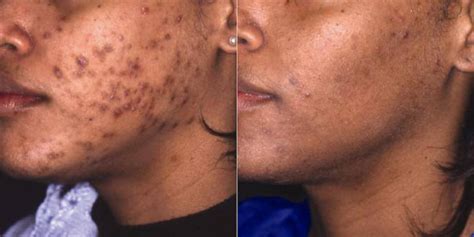 Why Do Dark Spots Get Darker Before They Get Lighter Vivant Skin Care