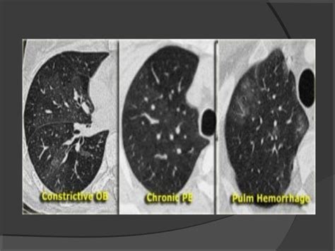 Hrct chest technique and interpretation