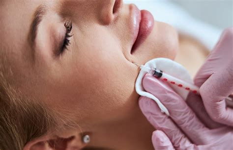 Dermal Fillers Montreal Nasolabial Folds Treatment