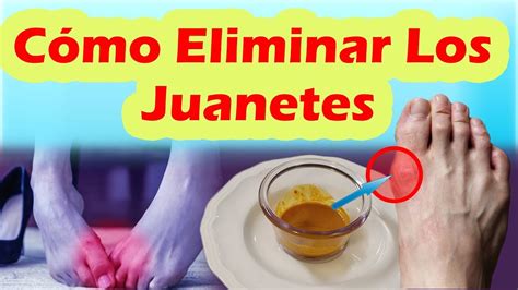 Como Eliminar Los Juanetes De Forma Natural Como Corregir Los Juanetes