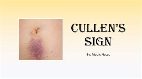 Cullen's sign/periumbilical ecchymoses - causes, pathophysiology - YouTube