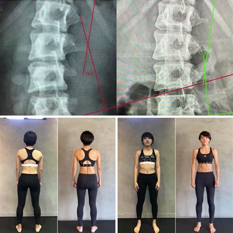 脊椎側彎Scoliosis Functional Patterns Taiwan