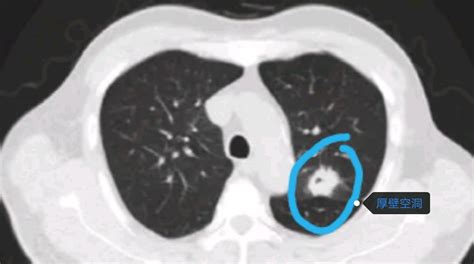 另类肺结节空洞型肺癌 健康160