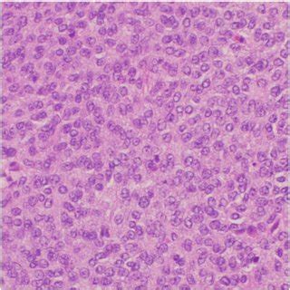 Adult Granulosa Cell Tumor With Solid Growth Pattern Consisting Of