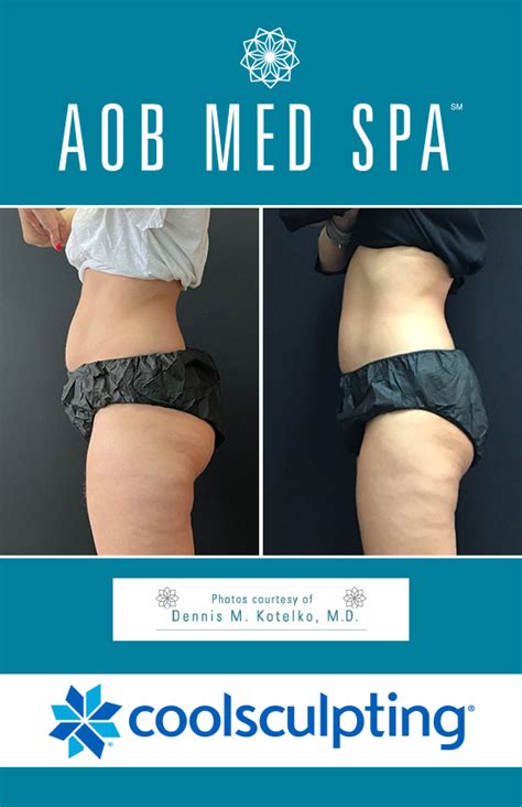 Coolsculpting Before And After Results Body Contouring With