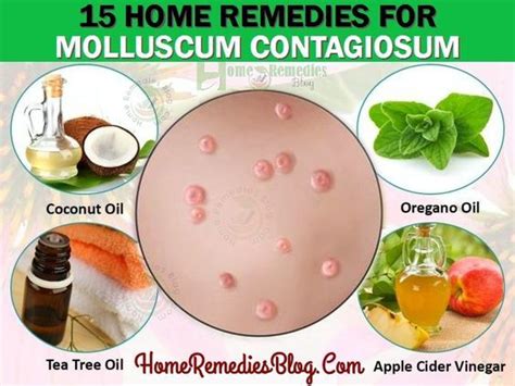 15 Home Remedies For Molluscum Contagiosum Natural Treatment Skin Problems Remedies Remedies