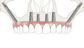 Zygoma Implants Waldorf MD, Southern Maryland Oral & Maxillofacial Surgery