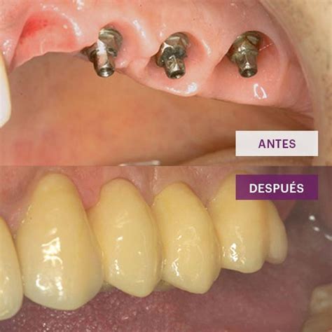 Casos Cl Nicos Antes Y Despu S Cl Nica Odontolog A Especializada