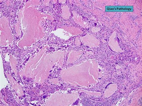 Qiao S Pathology Pilomatrixoma Microscopic Photo H E S Flickr