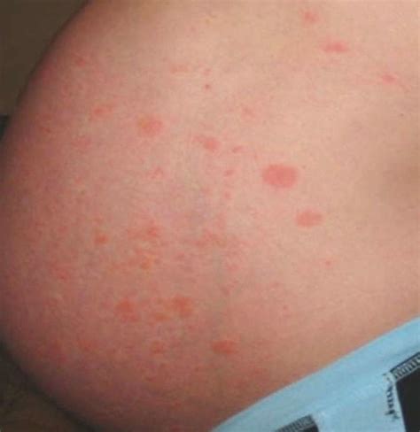 Pruritic Urticarial Papules And Plaques Of Pregnancy First Trimester