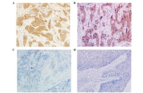 Prognostic Significance Of Claudin 1 And Cyclin B1 Protein Expression