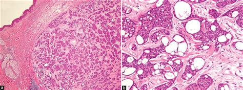 Primary Cutaneous Cribriform Apocrine Carcinoma Case Report And