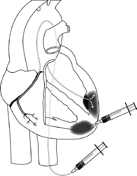 Current Strategies Of Stem Cell Application To The Heart Intracoronary