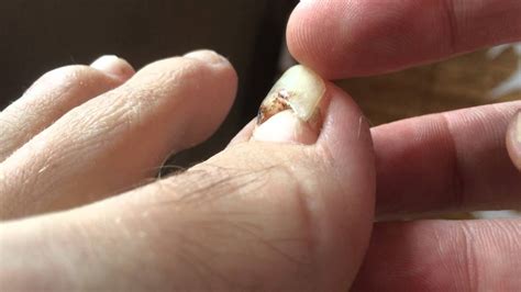 Detached Toenail About To Fall Off Youtube