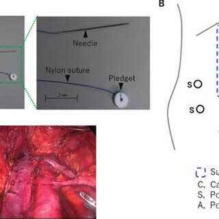 Peritoneal Traction Using The Laptraction During Laparoscopic