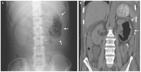 Emphysematous Pyelonephritis Ultrasound