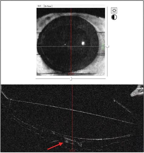 Screenshot From Intraoperative Optical Coherence Tomography Immediately Download Scientific