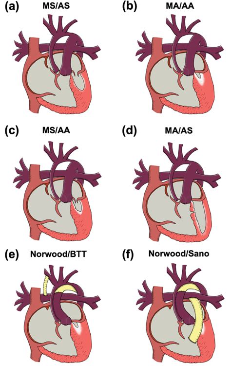 Hypoplastic Left Heart Syndrome Intechopen