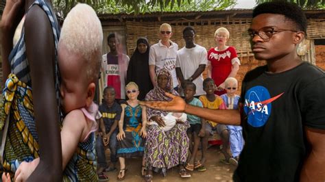 A cruel caça AOS albinos em Africa conheça a història de aniee Alfred