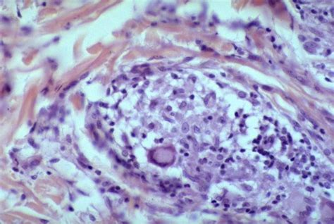 Pathology of Leprosy - Dr Sampurna Roy MD