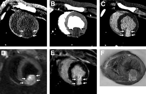 Assessment Of Myocardial Edema By Computed Tomography In Myocardial