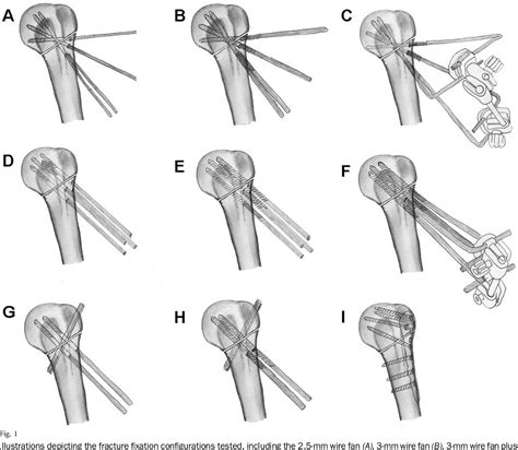 Figure From The Stability Of Percutaneous Fixation Of Proximal